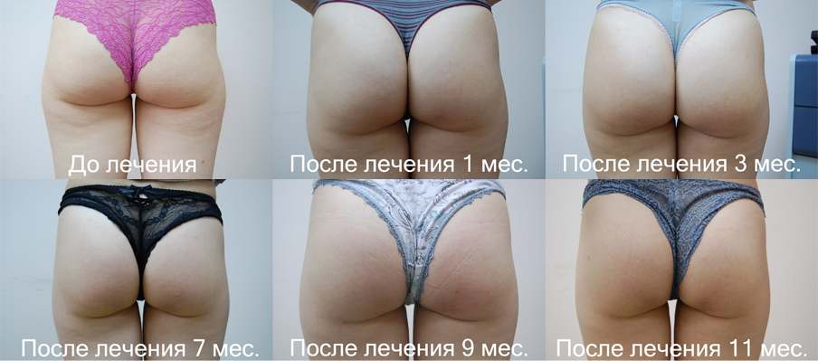результат лечения целюлита 1 ударно-волновой терапией