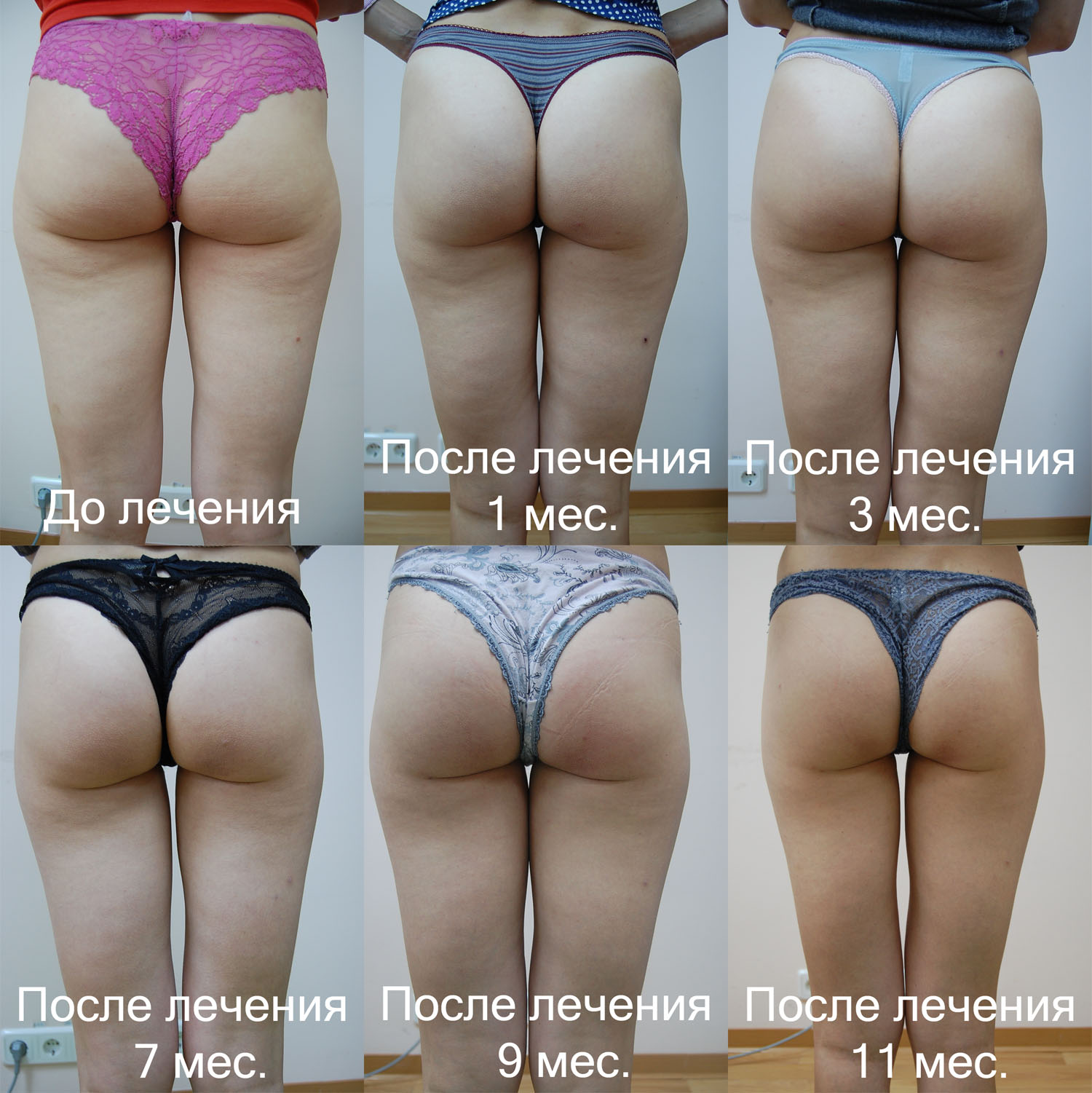 результат лечения целюлита 2 ударно-волновой терапией