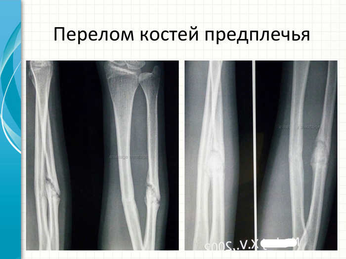 Замедленная консолидация перелома более 8 месяцев. Ударно-волновая терапия в лечении переломов и замедленной консолидации переломов