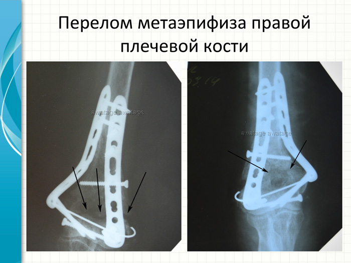 Перелом метаэпифиза плечевой кости, лечение методом РУВТ.